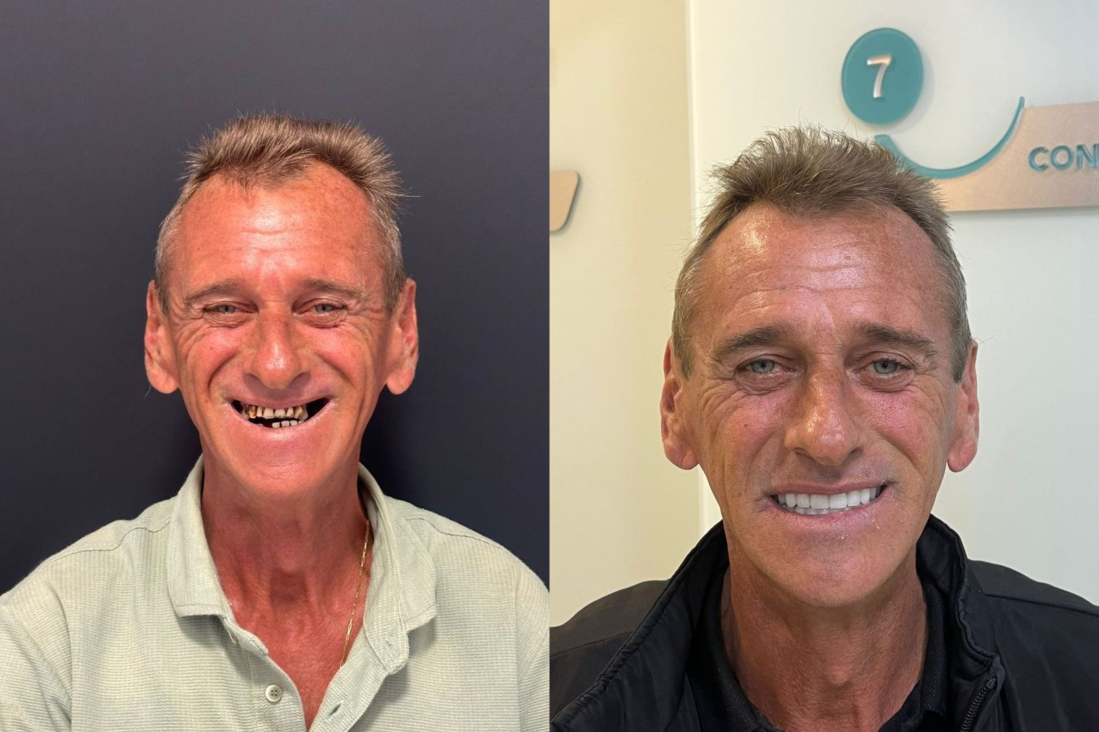Antes e depois de paciente da Oral Unic Timbó — reabilitação oral