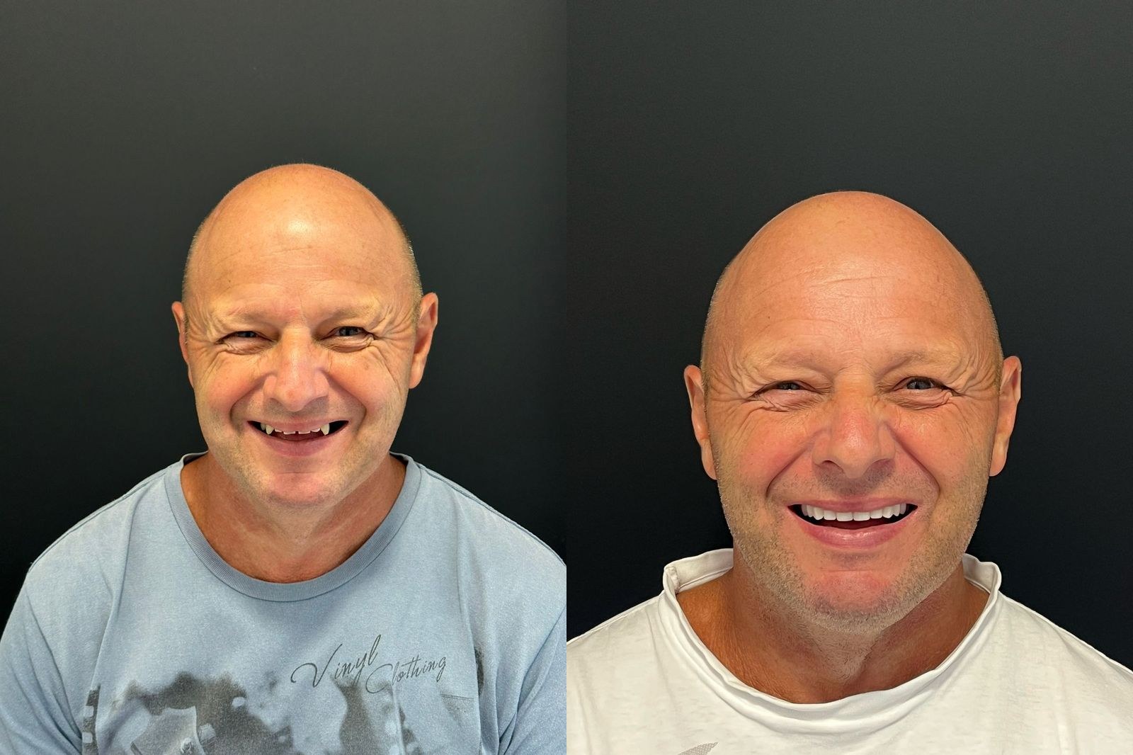 Antes e depois de paciente da Oral Unic Timbó — reabilitação oral